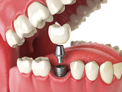 How Many Dental Implants Can You Get?