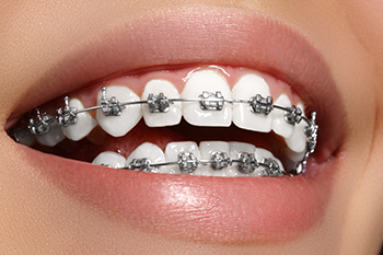 Traditional Braces Seattle South Lake Union Wa