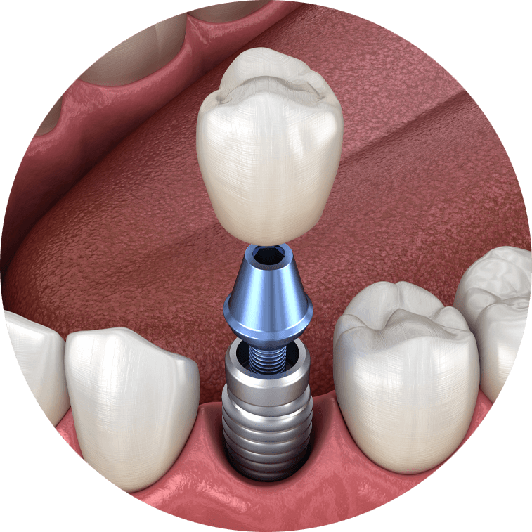 Single dental implant model showing crown abutment and implant.
