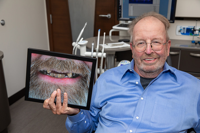 Male full mouth dental implant patient in blue shirt smiling holding a before picture with many missing teeth.