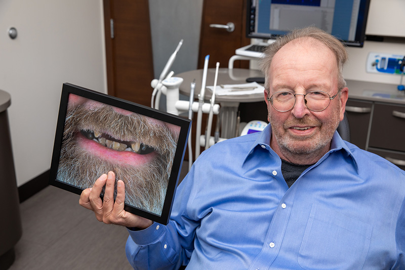 Male full mouth dental implant patient in blue shirt smiling holding a before picture with many missing teeth.