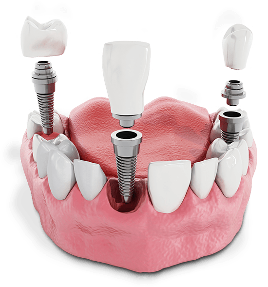 Model of a lower arch with multiple individual dental implants showing crown, abutment and implant.