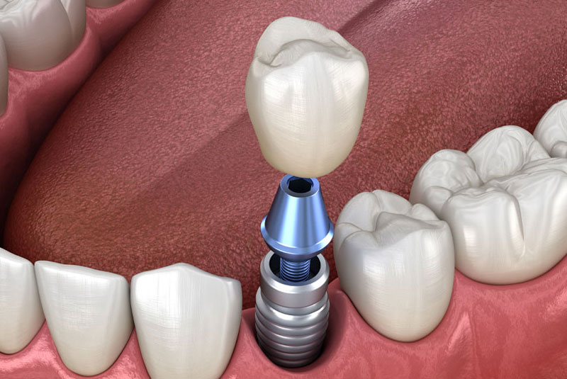 dental implant