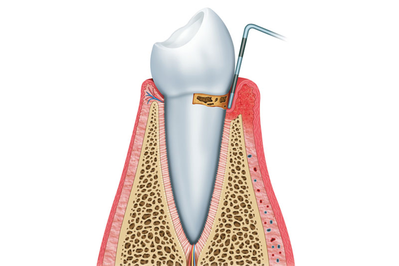 gingivitis stage1 perio