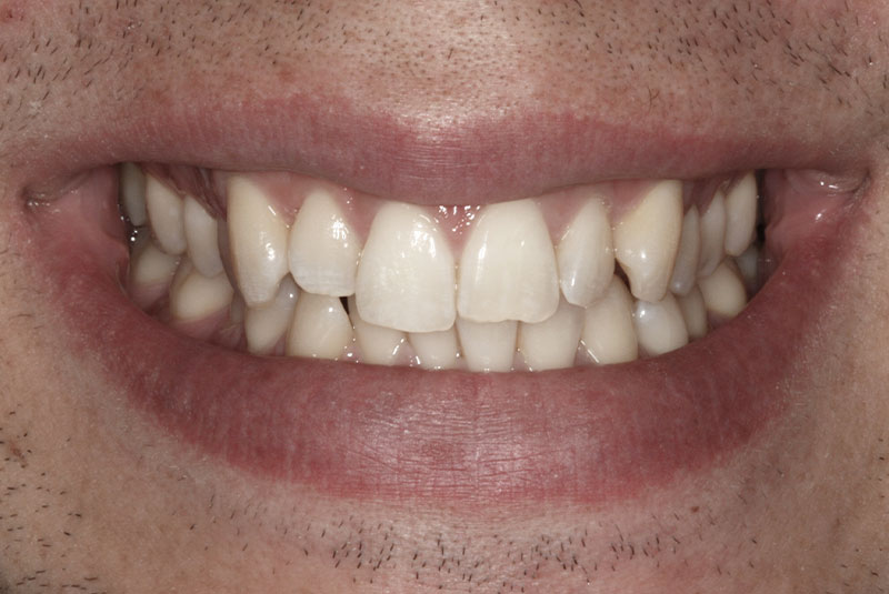 Orthodontic Patient Stories Kois Dentistry Seattle South Lake Union WA